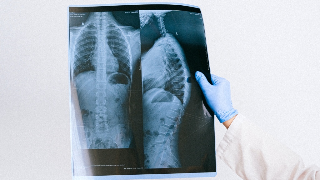 A través de la Inteligencia Artificial: Investigadores descubren sesgos en el diagnóstico de COVID-19 mediante rayos X